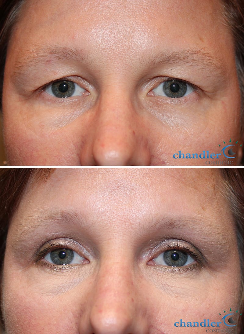 upper blepharoplasty