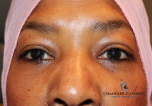 eye bag removal lower blepharoplasty after