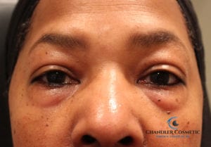 eye bag removal lower blepharoplasty before