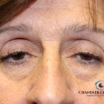 ptosis eyelift eyelid surgery before