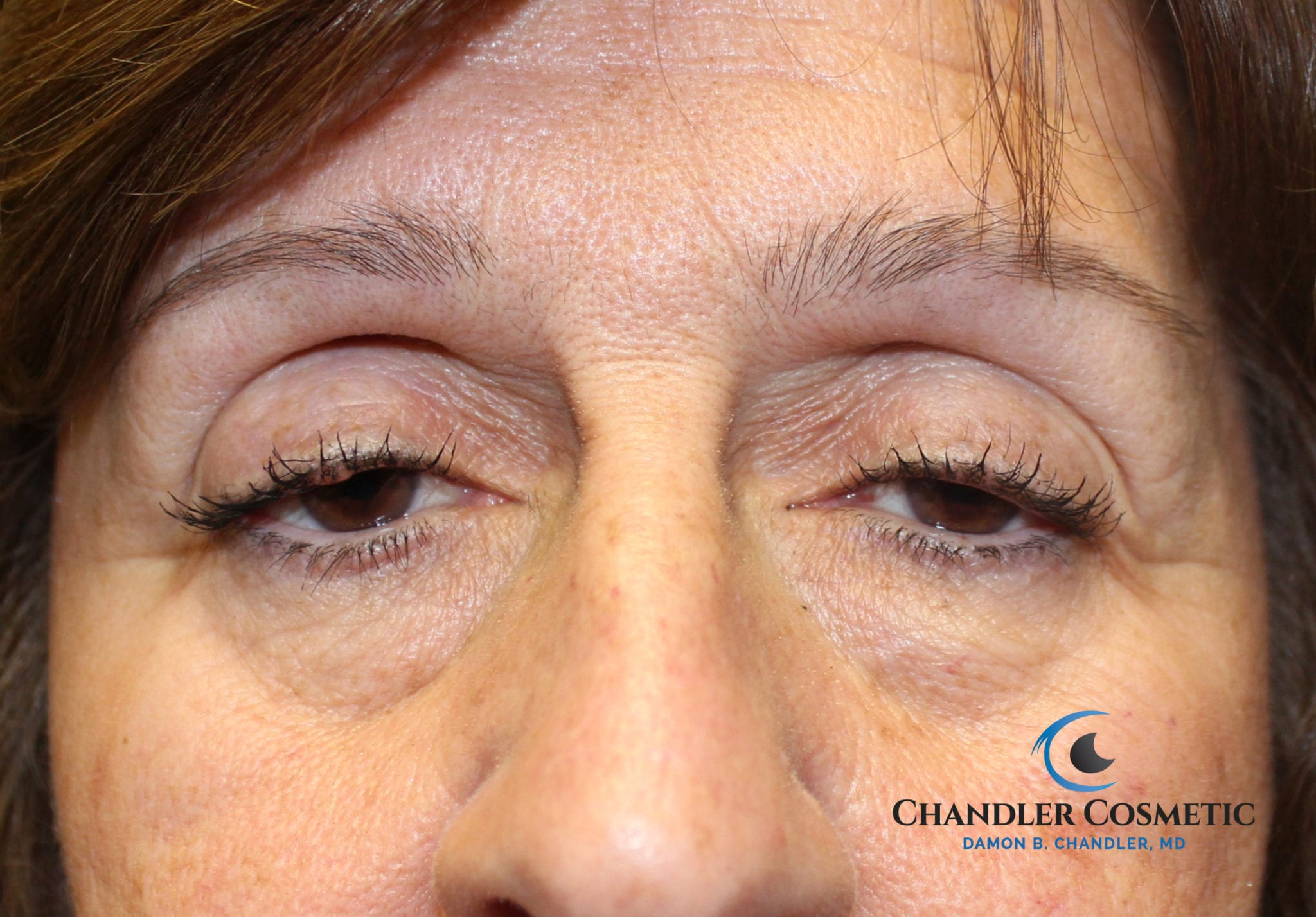 Ptosis Surgery Moorestown, NJ