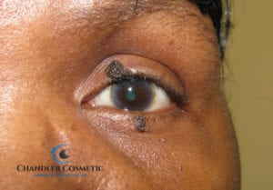 face mole removal eyelid growths woman before