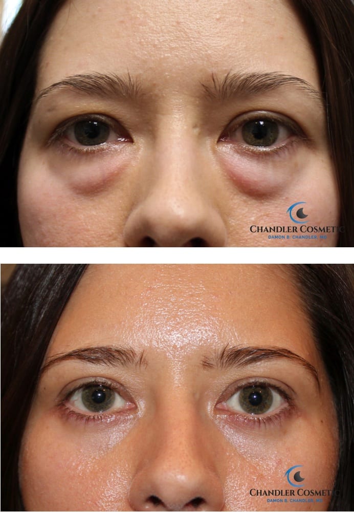 Cosmetic Procedures Under Eye Bags IUCN Water