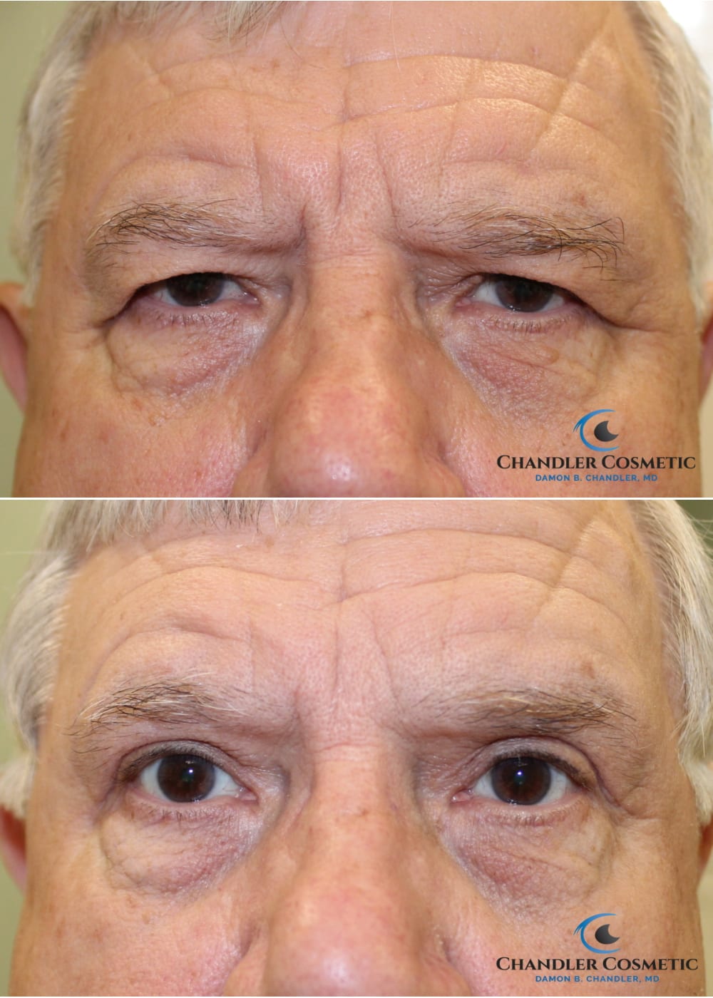 brow lift endoscopic brow lift before and after