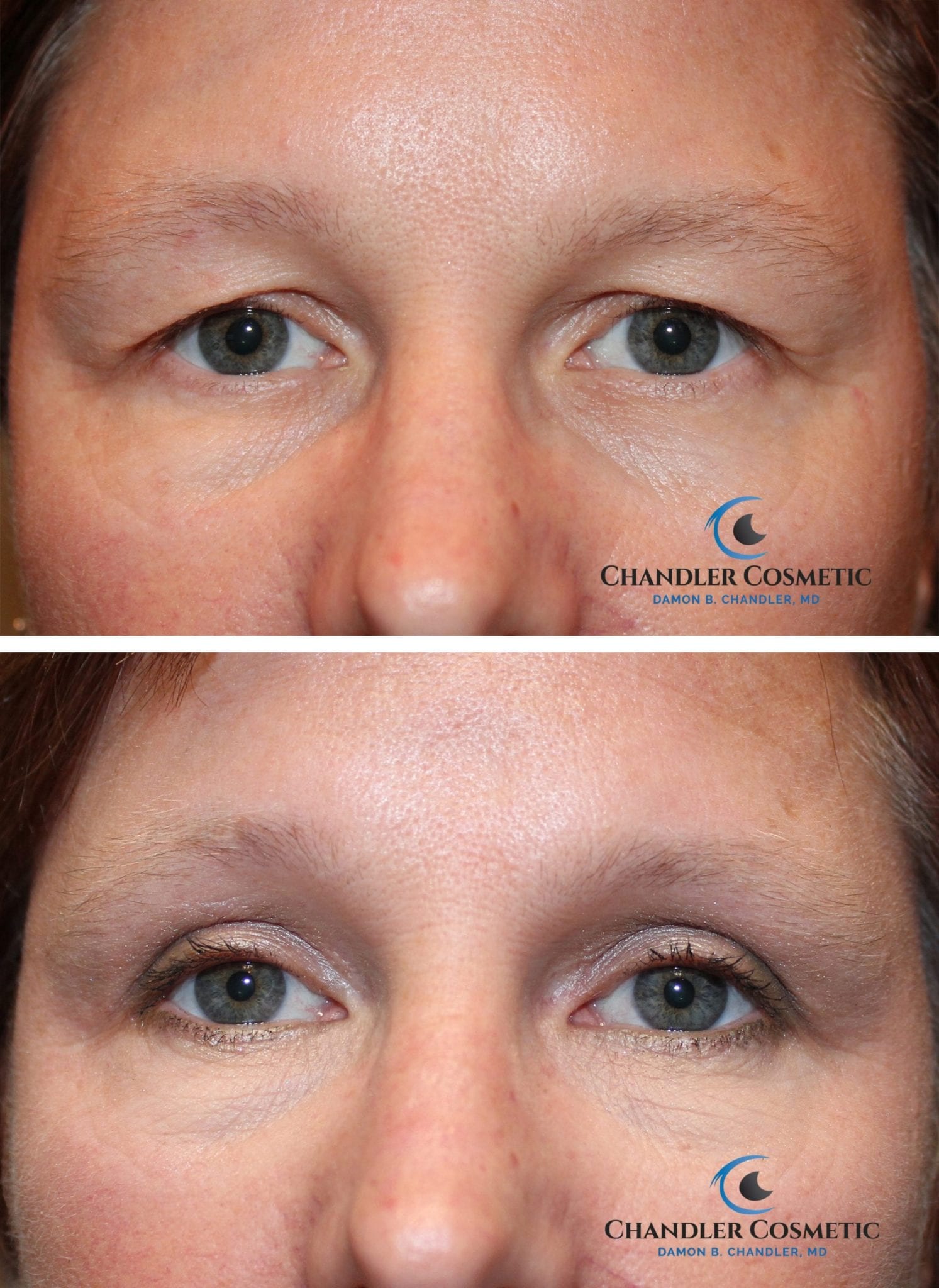 Upper Eyelid Surgery in Philadelphia Blepharoplasty PA