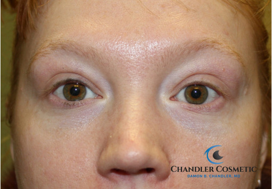 Puffy Eyes and Bags with Eyelid Surgery