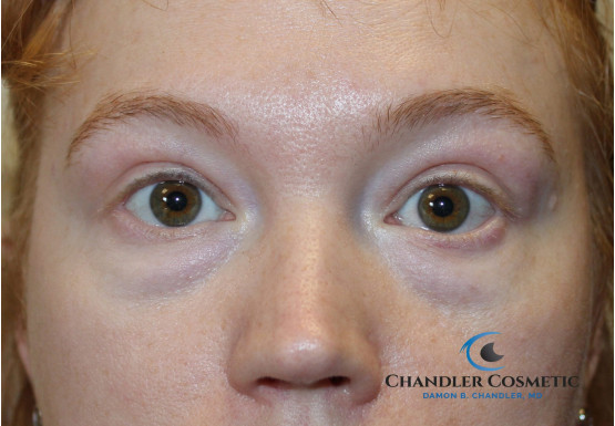 eyelid surgery philadelphia