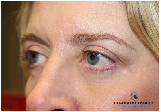 Lower Blepharoplasty Before and After